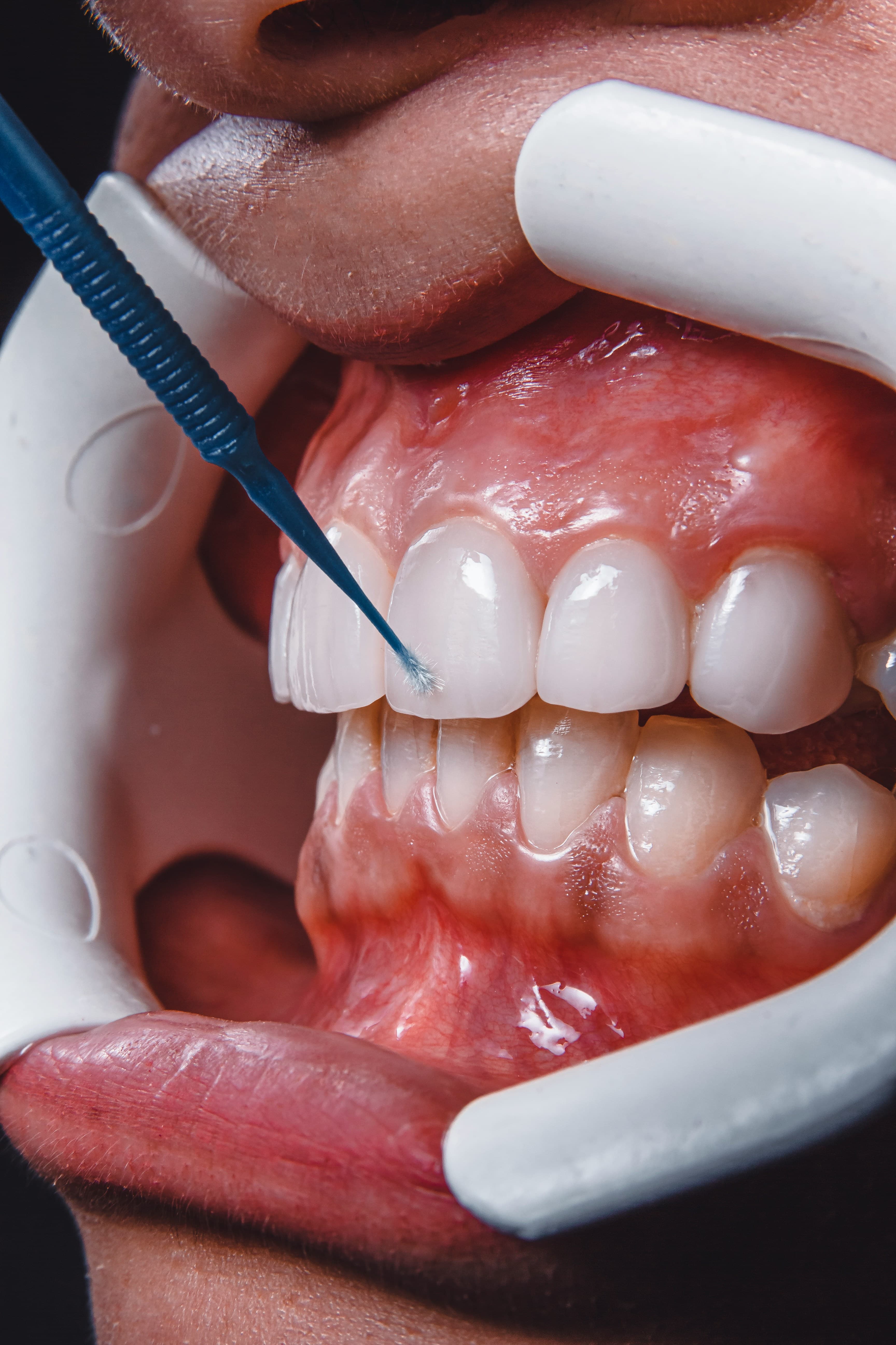 Chirurgie muco-gingivale