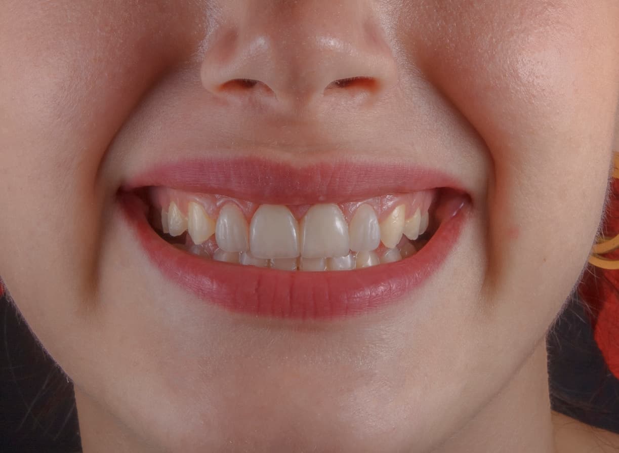 Dents de sagesse